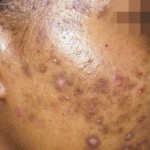 postinflammatorisk hyperpigmentering