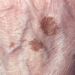 åldersfläckar-hand